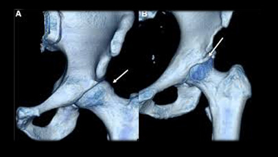 3D CT of Femoroacetabular impingement