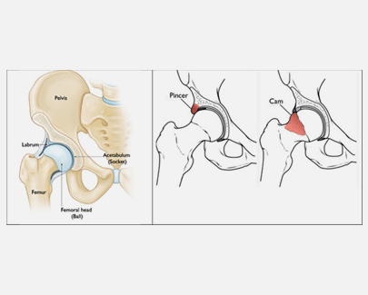 Femoroacetabular Impingement