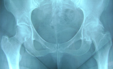 X-ray of normal and arthritic hips