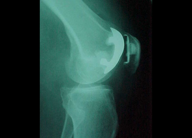 Side on X-ray of a patellofemoral replacement