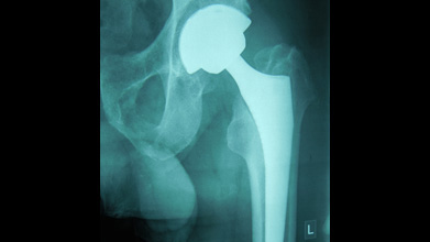 X-ray of total hip replacement