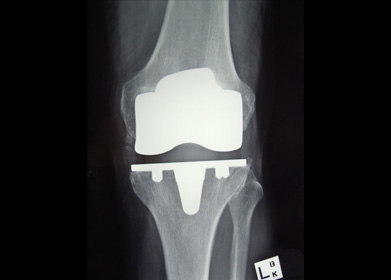 Xray of a total knee replacement