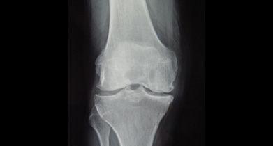 X-ray of mainly medial compartment OA to go with the unicompartmental replacement