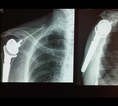 X-ray of a reverse shoulder replacement